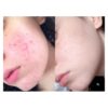 Prevent Hyperpigmentation